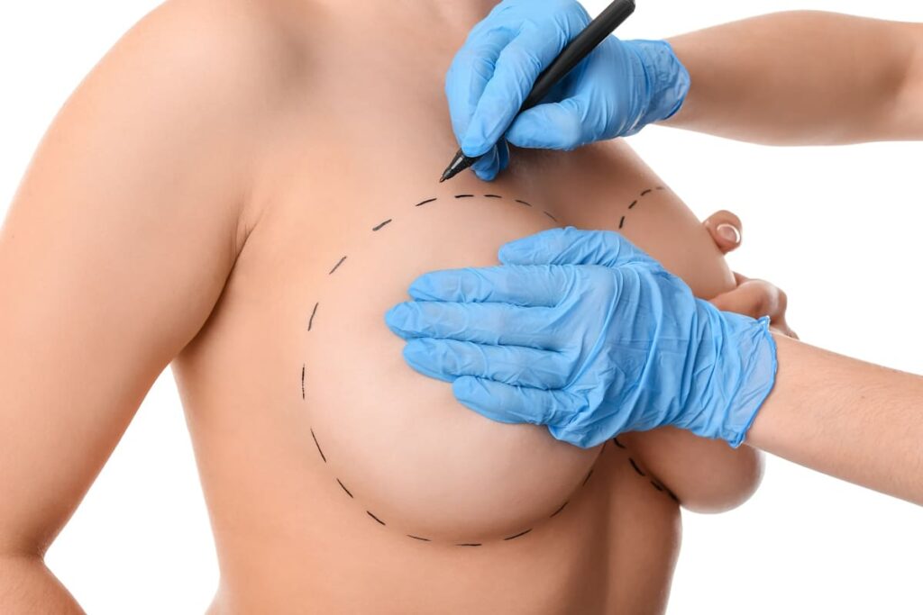 Mamoplastia de aumento